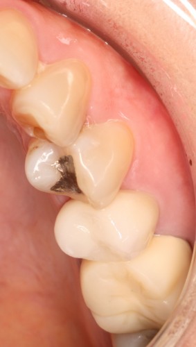 オールセラミッククラウン　左上5（自費）　と　ハイブリットクラウン　左上6（自費）